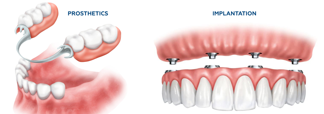 Dental Implants - What is important to know